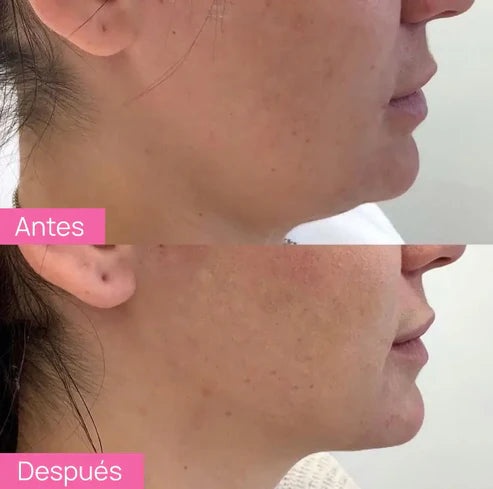 Dispositivo de Lifting Facial Skindion + Gel Conductor de REGALO