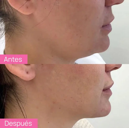 Dispositivo de Lifting Facial Skindion + Gel Conductor de REGALO